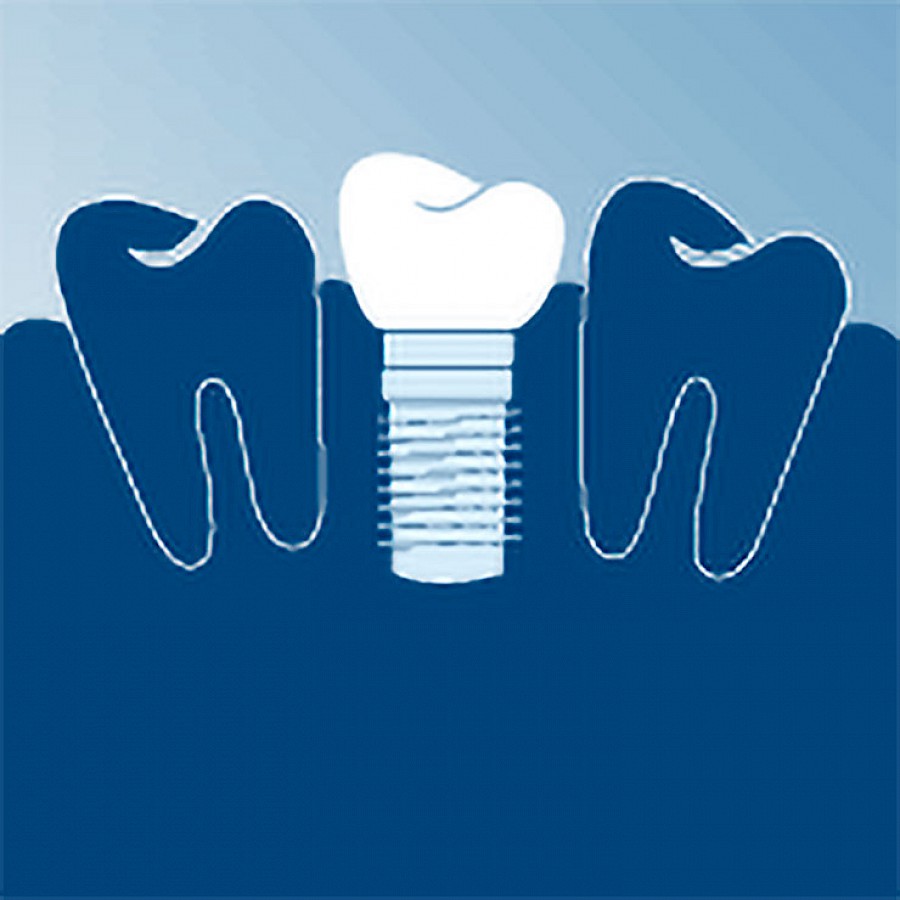 Zahnersatz auf Implantaten
